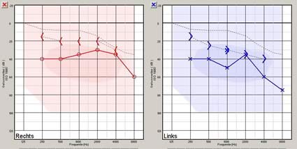 Audiogram