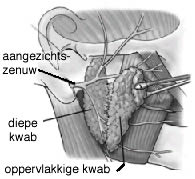 parotidectomie3